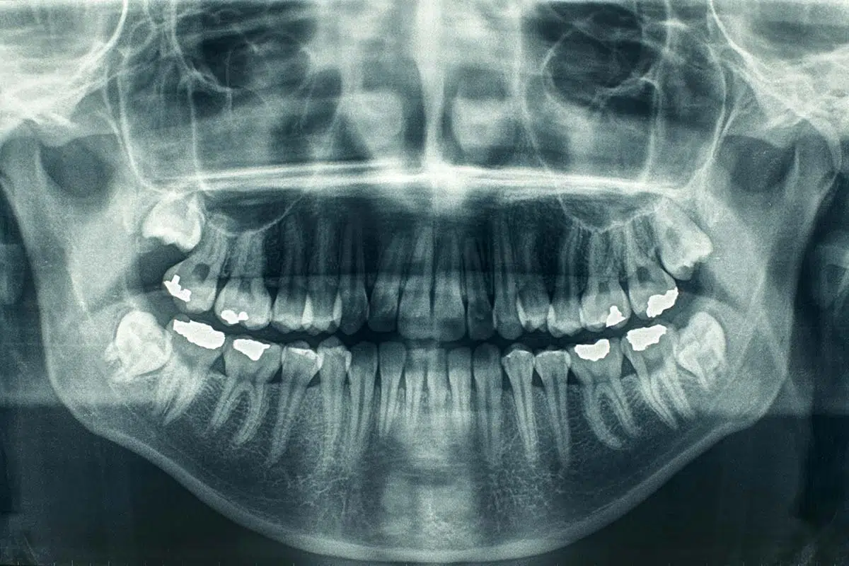 dental xray types risks